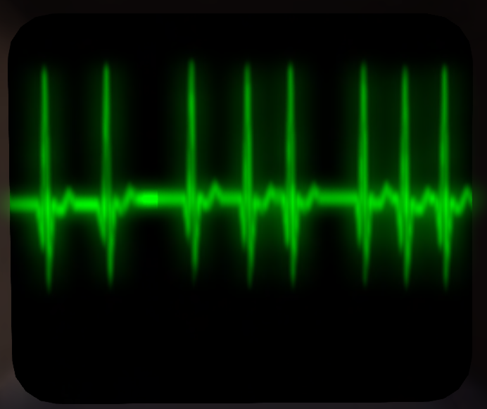 Ekg-stressed.png